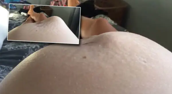 En gravid mage med synliga bristningar, som kan vara tecken på stressad bebis i magen.
