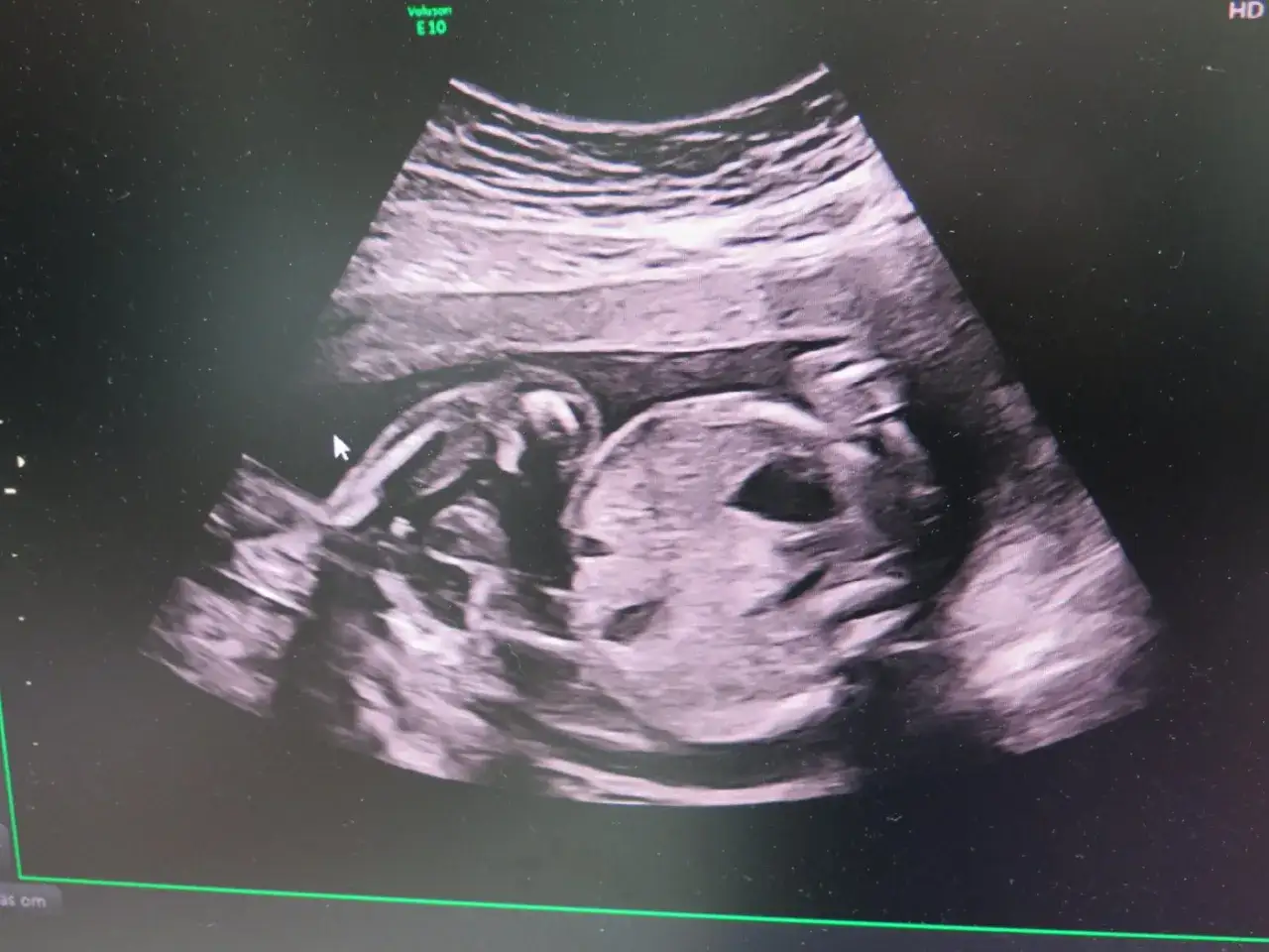 Ultraljudsbild visar ett foster, gravid vecka 18. Man ser barnets ansikte och kropp tydligt.