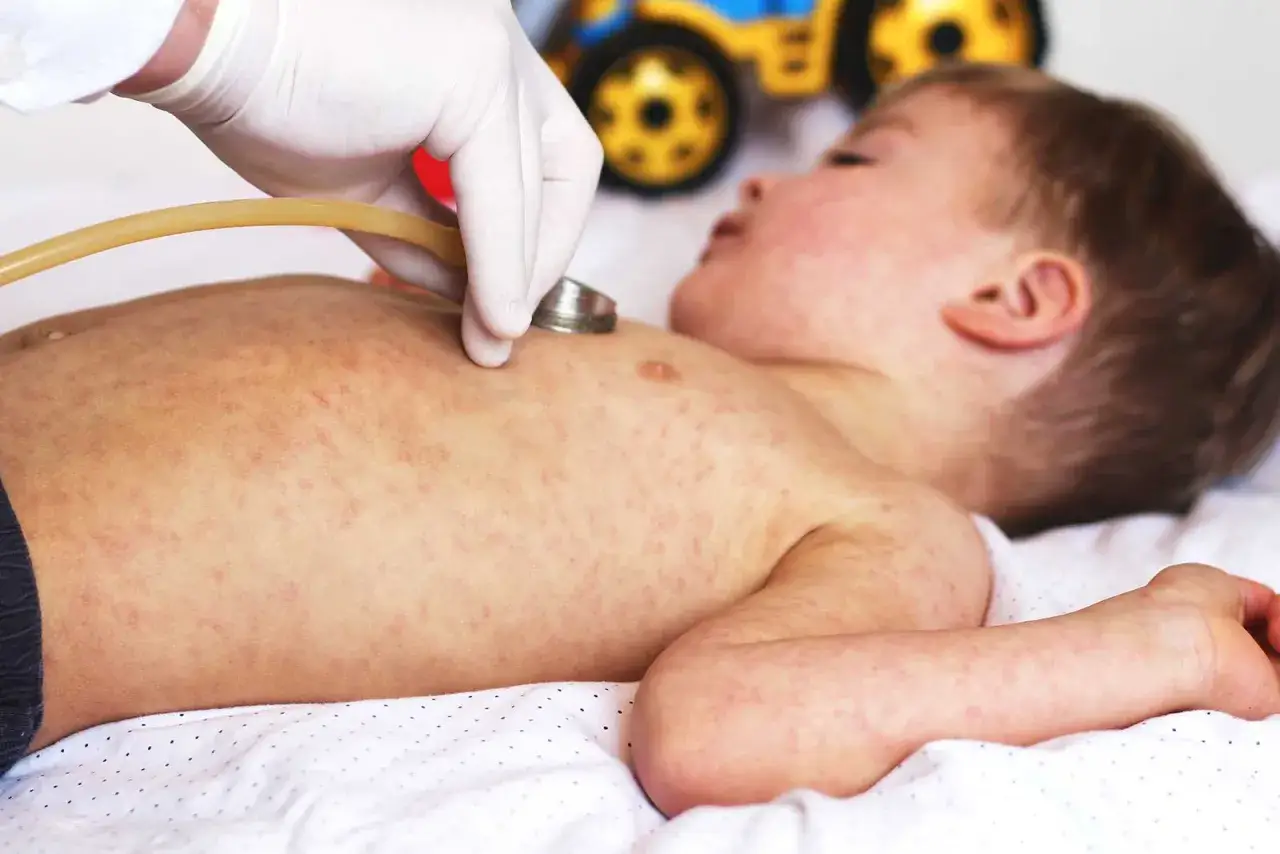 L&auml;kare unders&ouml;ker ett barn med utslag, m&ouml;jligen biverkningar efter 5 m&aring;naders vaccin.