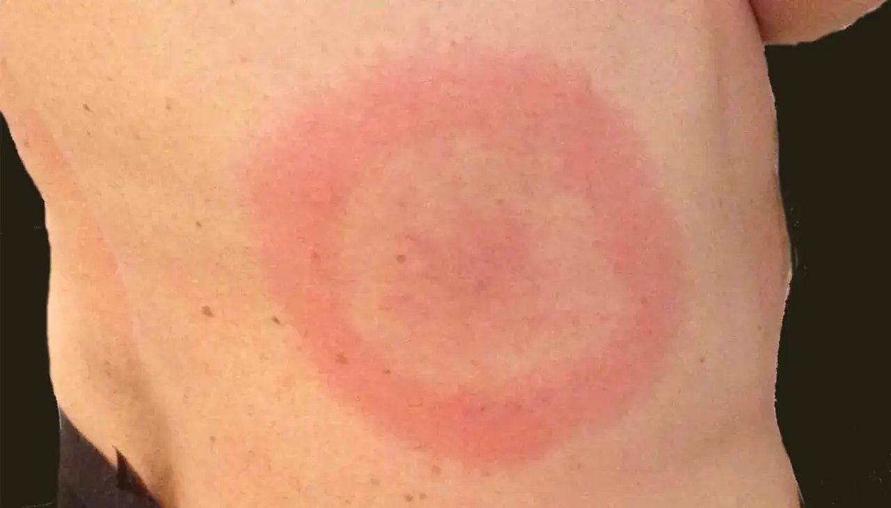 Hudutslag p&aring; en arm, m&ouml;jligt tecken p&aring; borrelia hos barn.