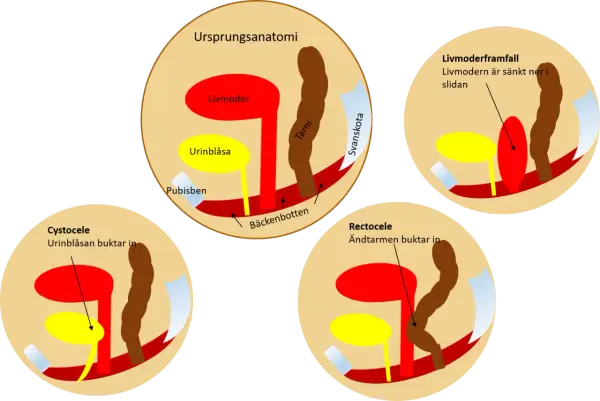 Illustrationer visar hur livmoderframfall, cystocele och rektosele ser ut.